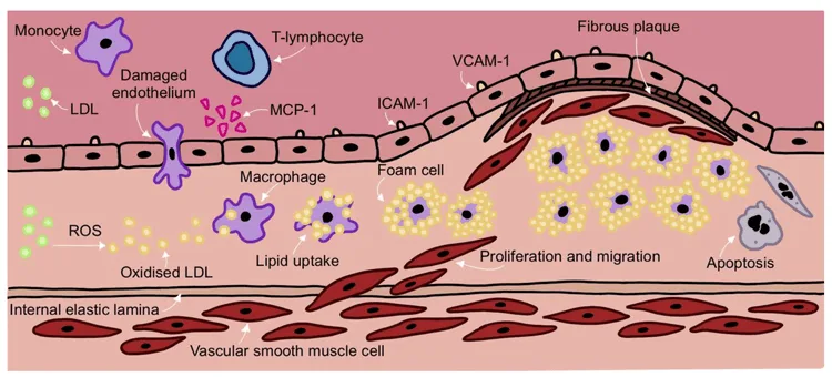 Plaque formation by cholesterol in artery